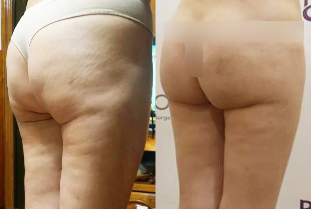 Body Depressed & Incision Scars before & after photo 8 · Bonita Clinic Seoul