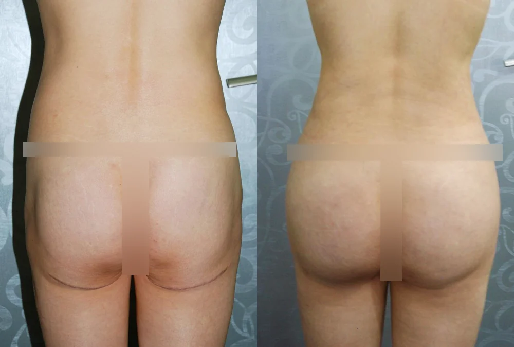 Body Depressed & Incision Scars before & after photo 10 · Bonita Clinic Seoul