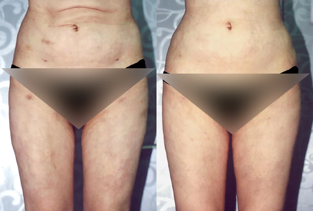 Body Depressed & Incision Scars before & after photo 11 · Bonita Clinic Seoul