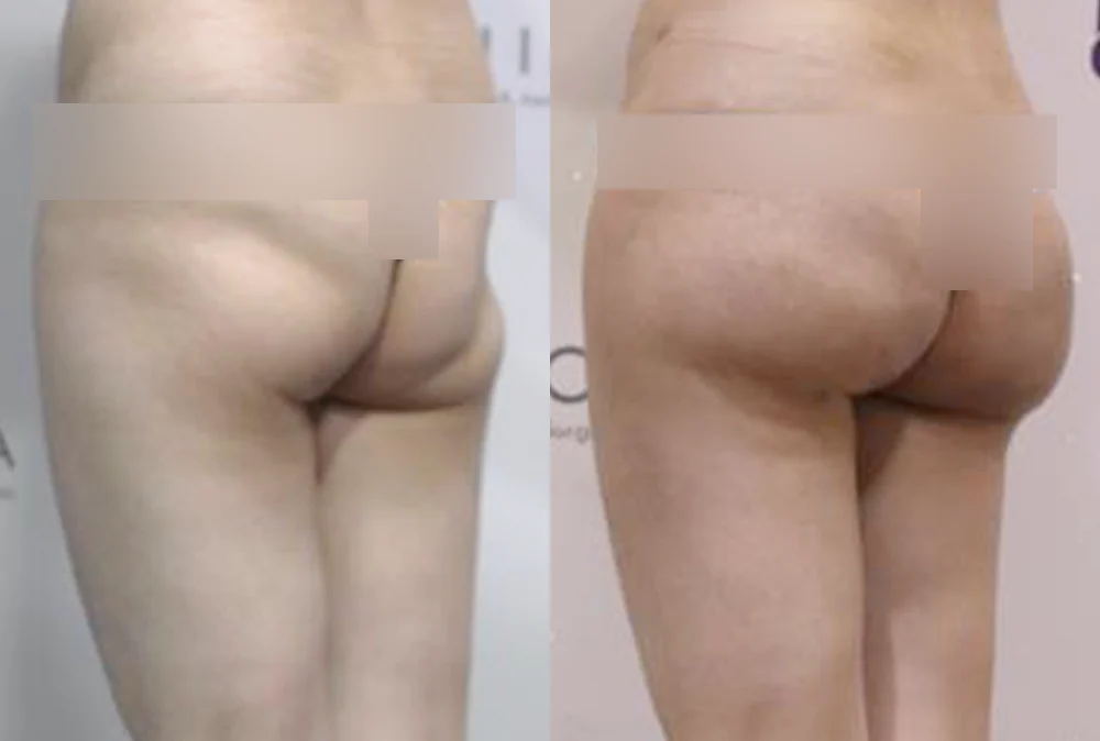 Body Depressed & Incision Scars before & after photo 12 · Bonita Clinic Seoul