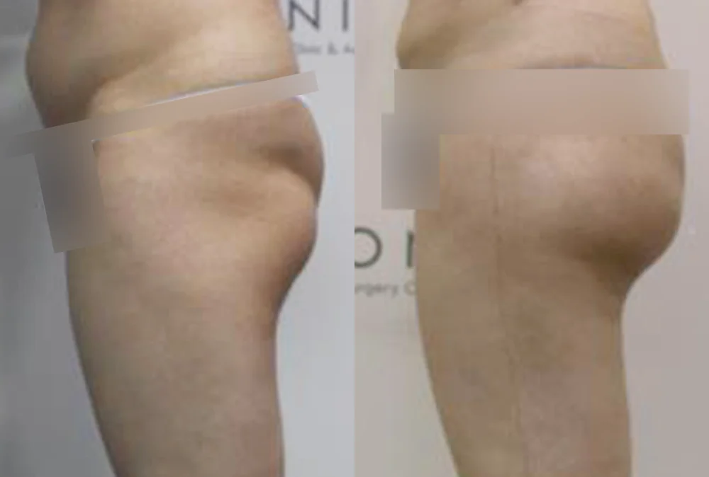 Body Depressed & Incision Scars before & after photo 13 · Bonita Clinic Seoul