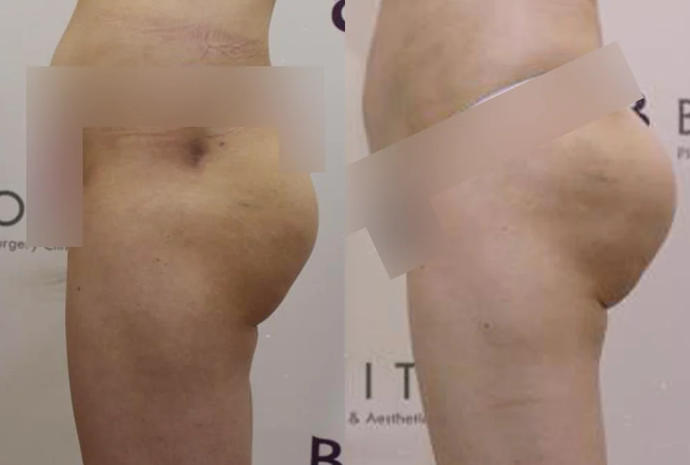 Body Depressed & Incision Scars before & after photo 14 · Bonita Clinic Seoul