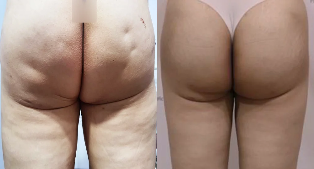 Body Depressed & Incision Scars before & after photo 15 · Bonita Clinic Seoul