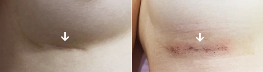 Body 성형 흉터 시술 전후 사진 13 · 보니따의원