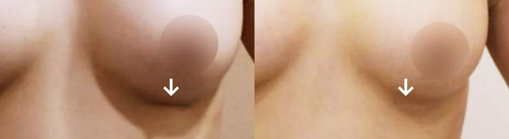 Body 성형 흉터 시술 전후 사진 14 · 보니따의원