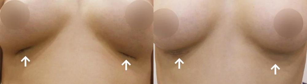 Body 성형 흉터 시술 전후 사진 15 · 보니따의원