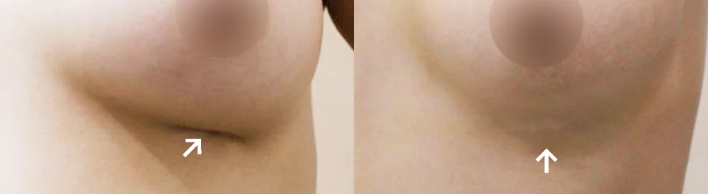 Body 성형 흉터 시술 전후 사진 16 · 보니따의원