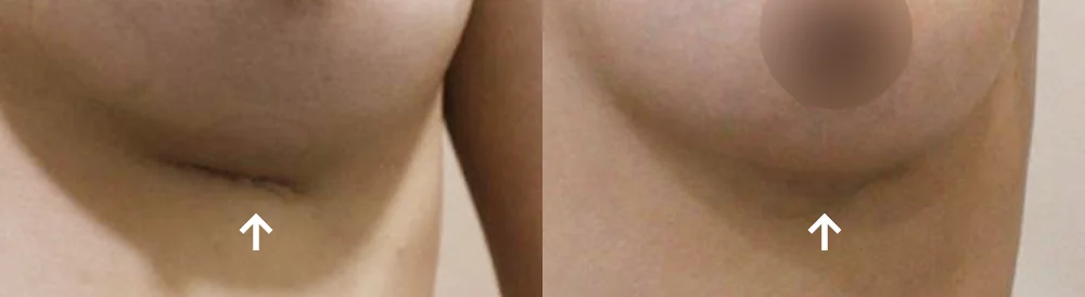 Body 성형 흉터 시술 전후 사진 17 · 보니따의원