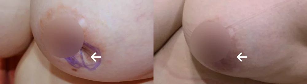 Body 성형 흉터 시술 전후 사진 19 · 보니따의원