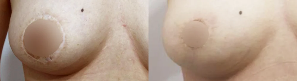 Body 성형 흉터 시술 전후 사진 20 · 보니따의원