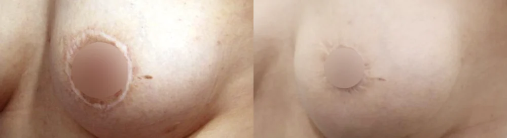 Body 성형 흉터 시술 전후 사진 21 · 보니따의원