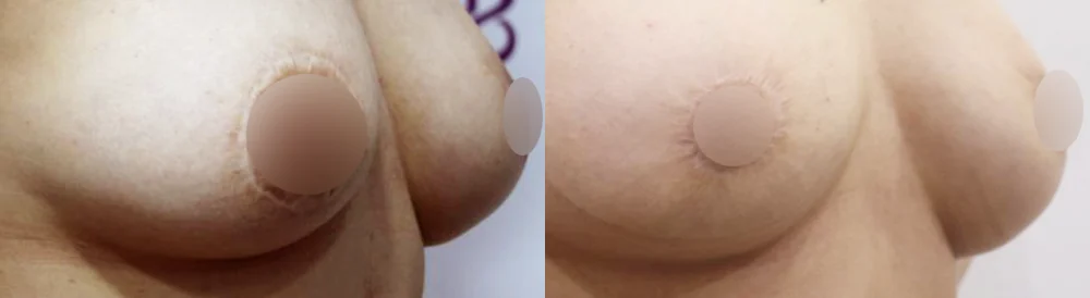 Body 성형 흉터 시술 전후 사진 22 · 보니따의원
