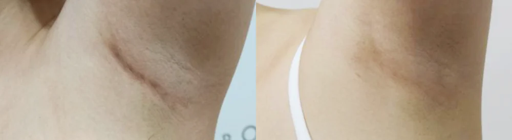 Body 성형 흉터 시술 전후 사진 23 · 보니따의원