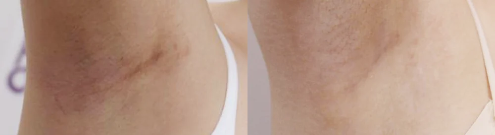 Body 성형 흉터 시술 전후 사진 24 · 보니따의원