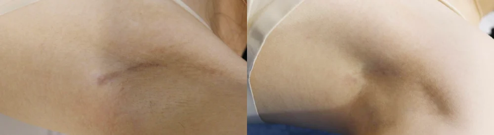 Body 성형 흉터 시술 전후 사진 25 · 보니따의원