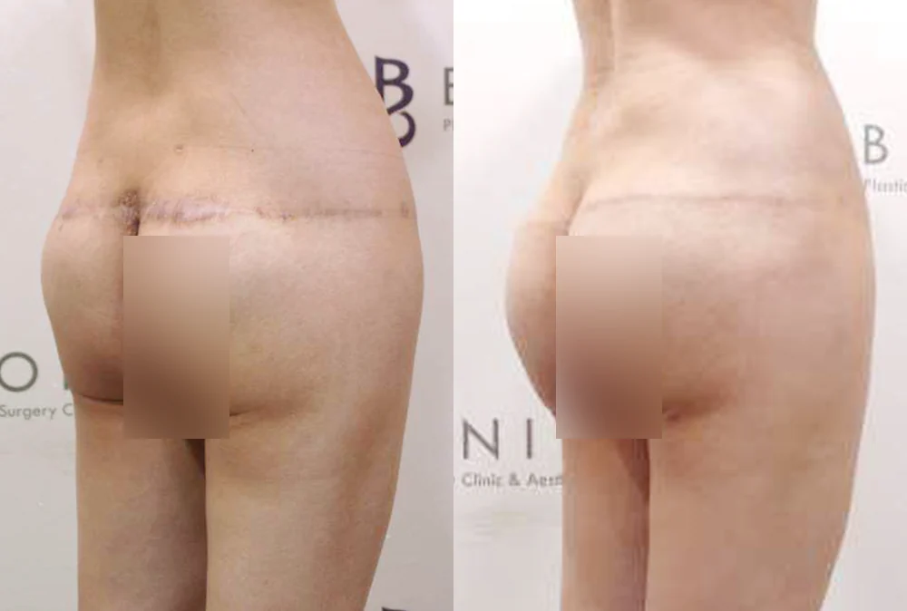 Body 성형 흉터 시술 전후 사진 3 · 보니따의원