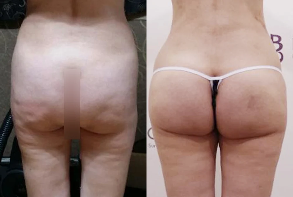 Body 성형 흉터 시술 전후 사진 1 · 보니따의원