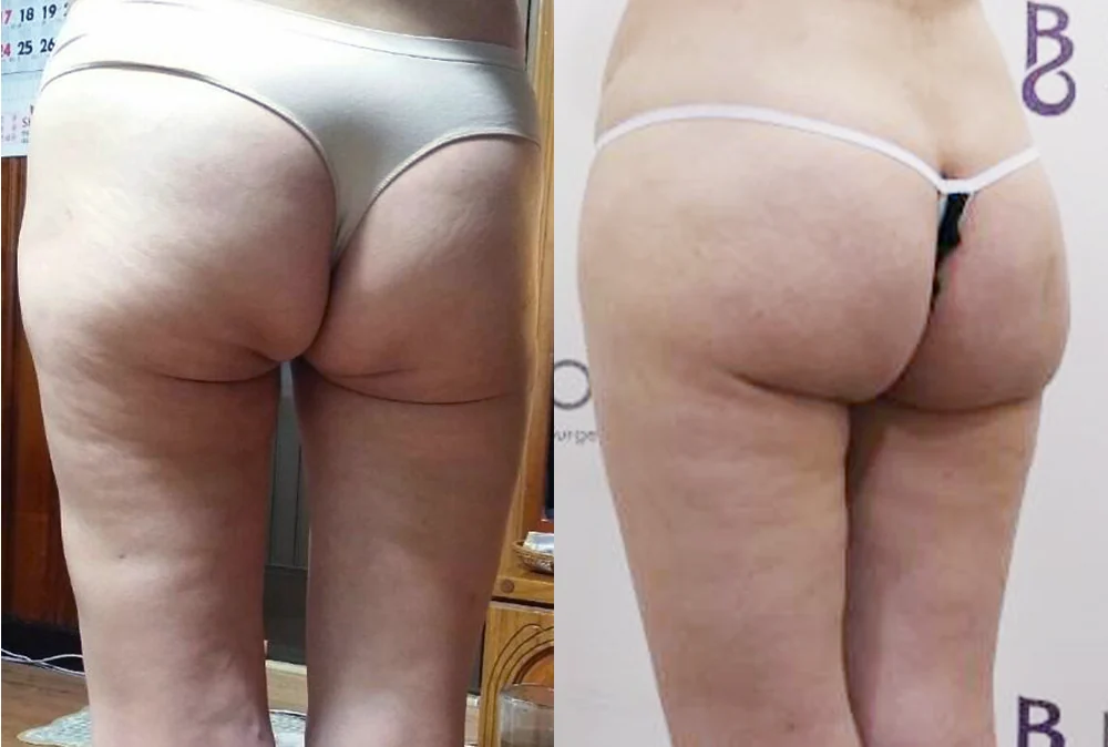 Body 성형 흉터 시술 전후 사진 4 · 보니따의원