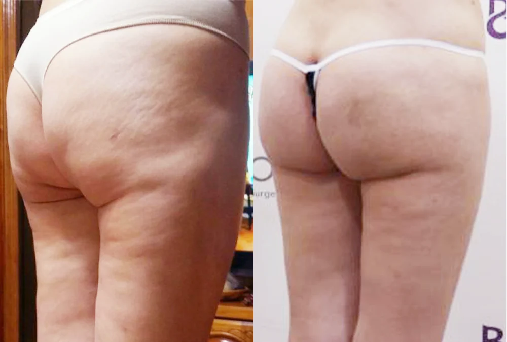 Body 성형 흉터 시술 전후 사진 5 · 보니따의원
