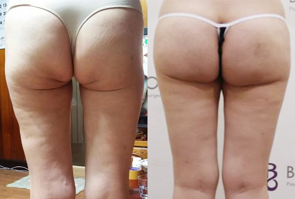 Body 성형 흉터 시술 전후 사진 6 · 보니따의원