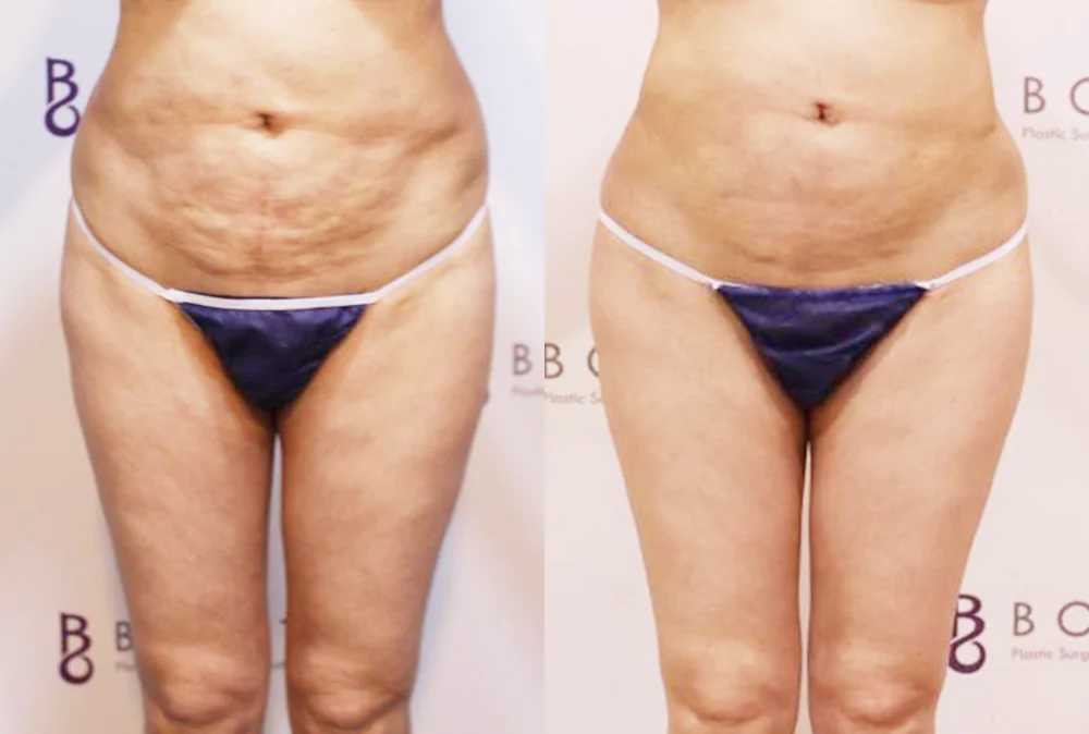 Body 성형 흉터 시술 전후 사진 8 · 보니따의원