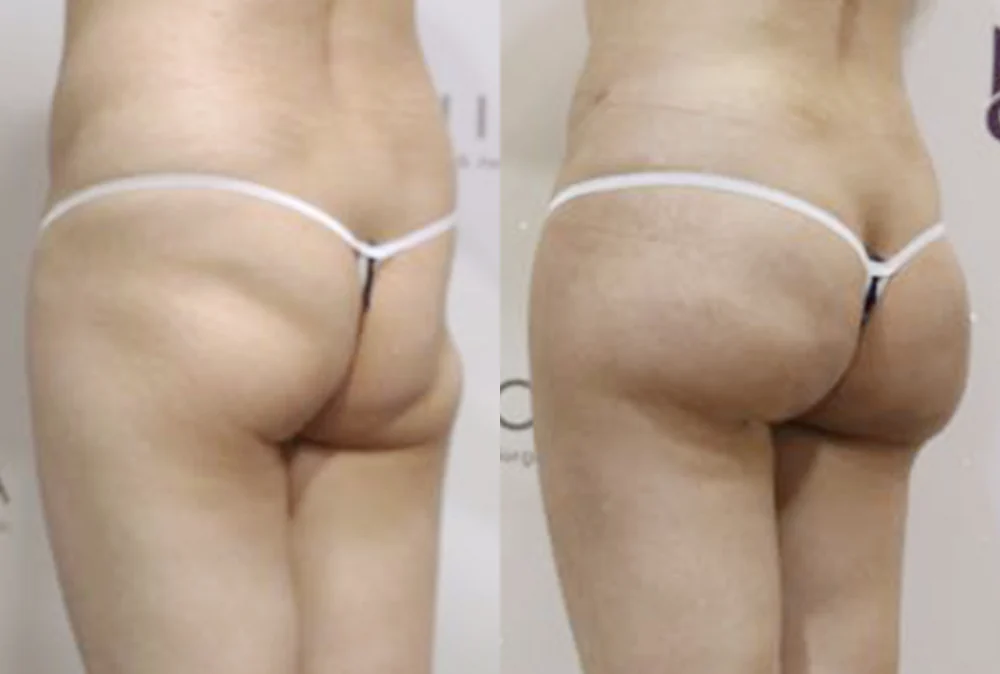Body 성형 흉터 시술 전후 사진 11 · 보니따의원