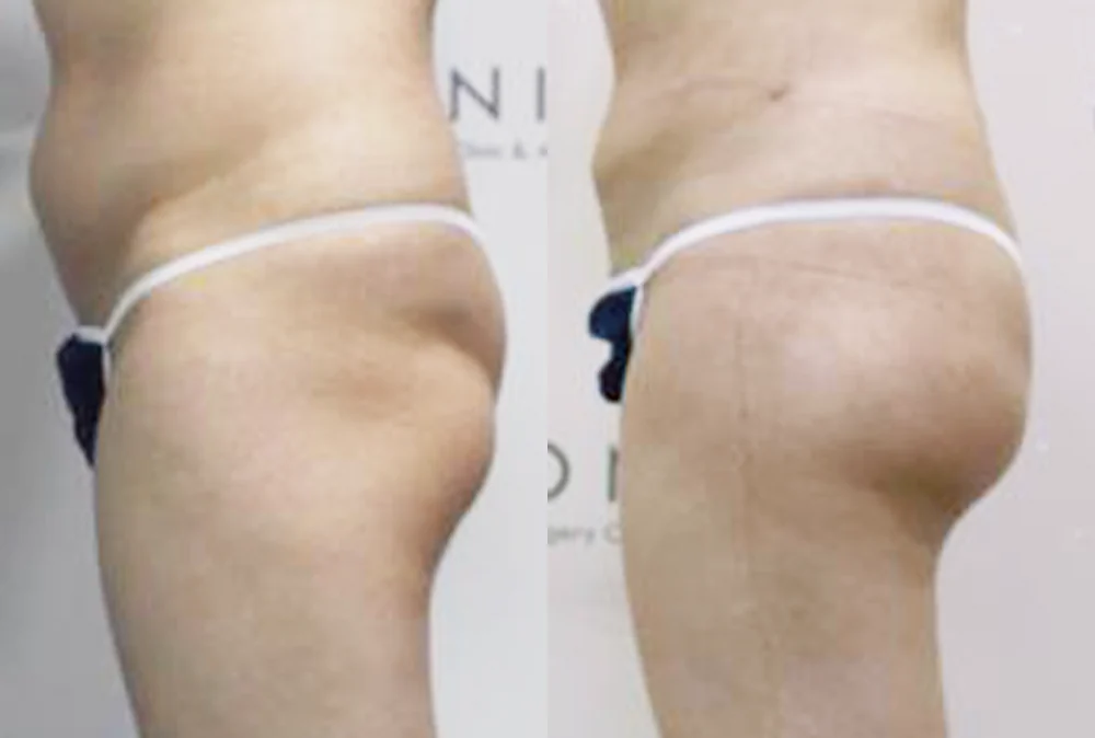 Body 성형 흉터 시술 전후 사진 12 · 보니따의원