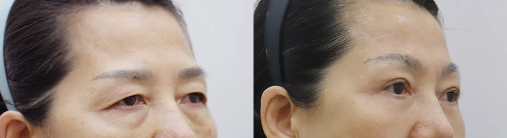 눈썹위거상 시술 전후 사진 6 · 보니따의원