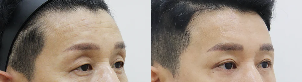 눈썹위거상 시술 전후 사진 9 · 보니따의원