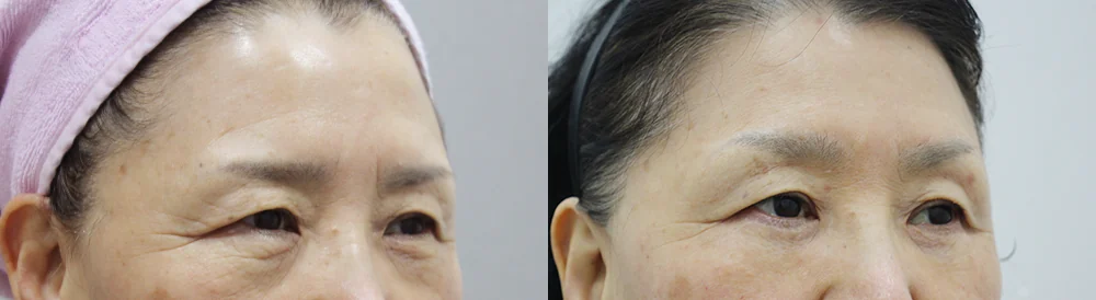 눈썹위거상 시술 전후 사진 12 · 보니따의원