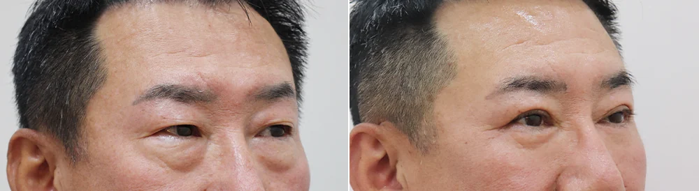 눈썹위거상 시술 전후 사진 18 · 보니따의원