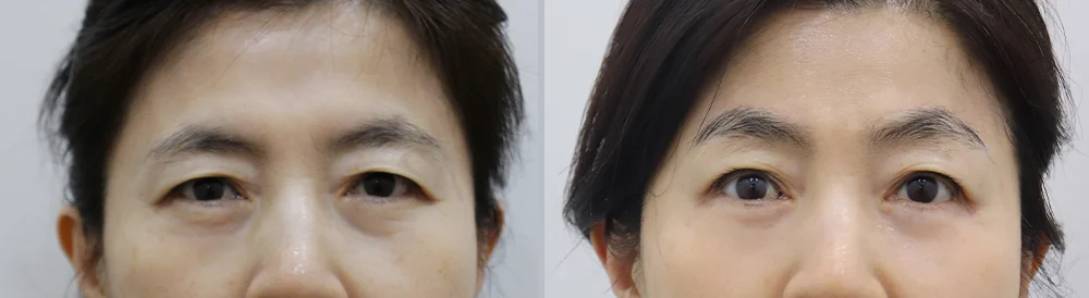 눈썹위거상 시술 전후 사진 19 · 보니따의원
