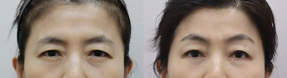 눈썹위거상 시술 전후 사진 20 · 보니따의원