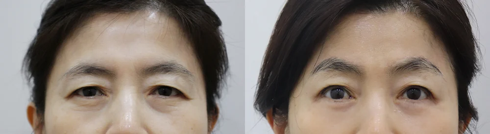 눈썹위거상 시술 전후 사진 21 · 보니따의원