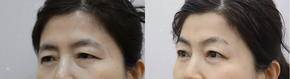 눈썹위거상 시술 전후 사진 22 · 보니따의원