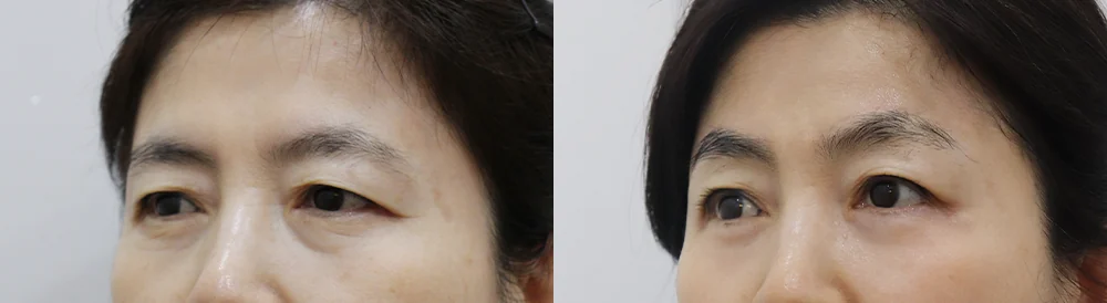 눈썹위거상 시술 전후 사진 23 · 보니따의원