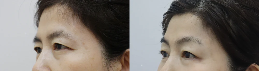 눈썹위거상 시술 전후 사진 24 · 보니따의원