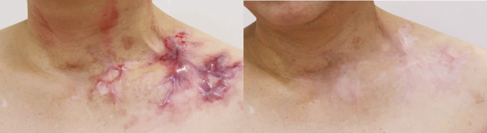 화상 흉터 시술 전후 사진 1 · 보니따의원