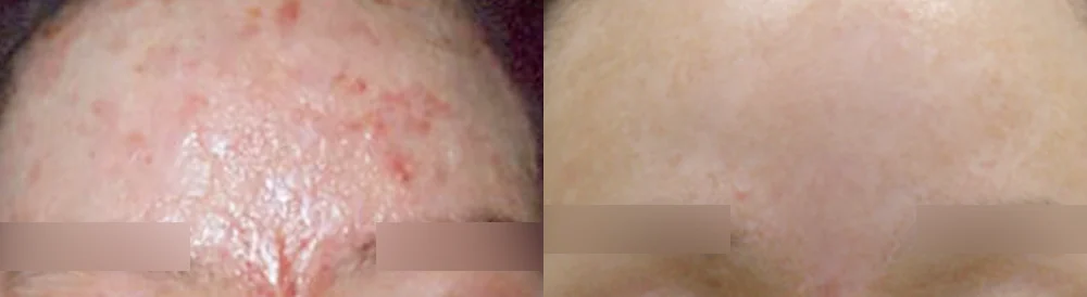 화상 흉터 시술 전후 사진 4 · 보니따의원