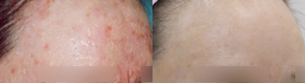 화상 흉터 시술 전후 사진 5 · 보니따의원