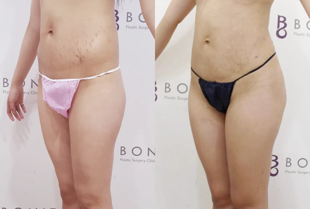 Body Contouring Center before & after photo 5 · Bonita Clinic Seoul