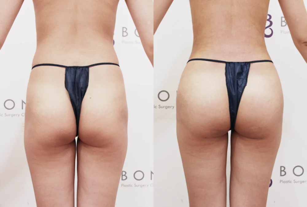 Body Contouring Center before & after photo 9 · Bonita Clinic Seoul