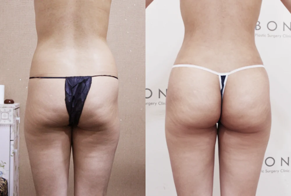 브라질리언 레이어드 힙업성형 시술 전후 사진 9 · 보니따의원