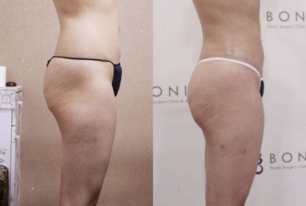 브라질리언 레이어드 힙업성형 시술 전후 사진 10 · 보니따의원
