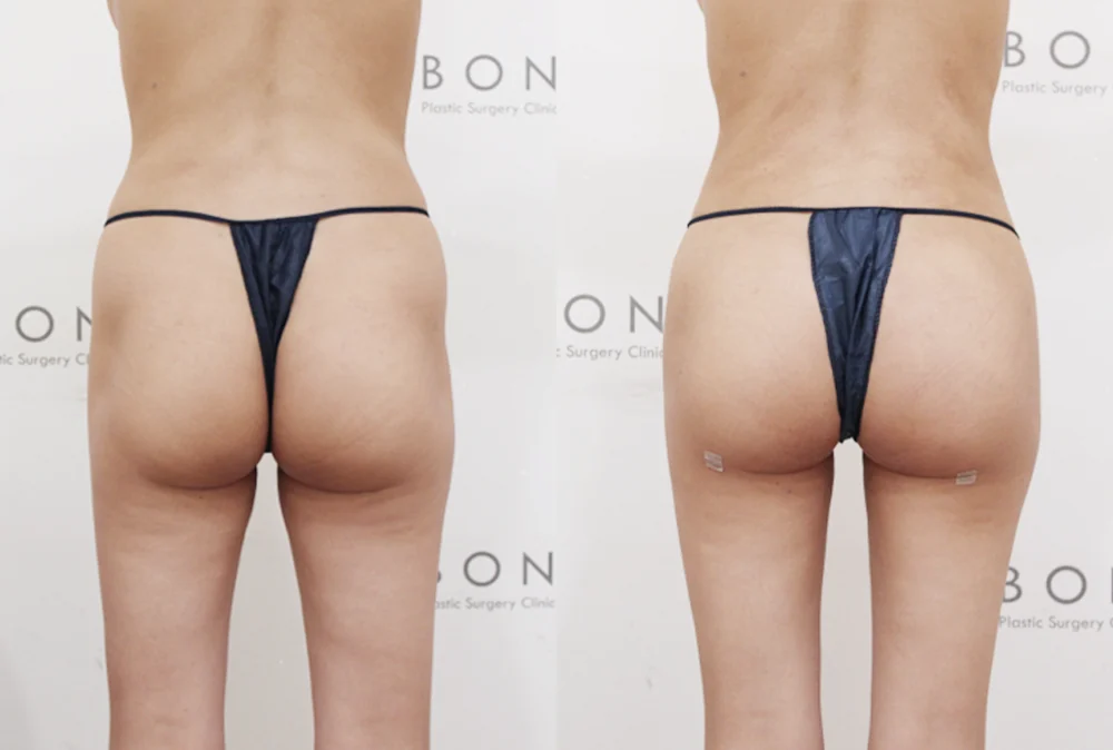 브라질리언 레이어드 힙업성형 시술 전후 사진 13 · 보니따의원