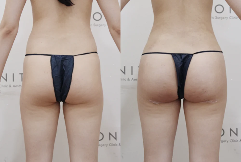 브라질리언 레이어드 힙업성형 시술 전후 사진 15 · 보니따의원