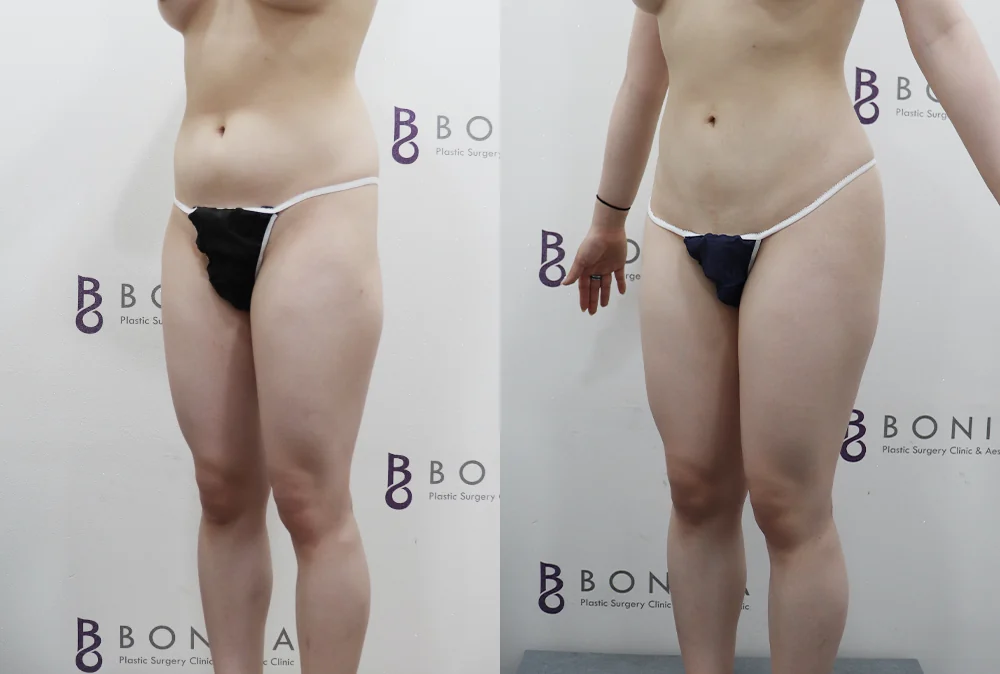 ヒップへの脂肪注入(豊尻) 術前術後の写真 61 · ボニータクリニック