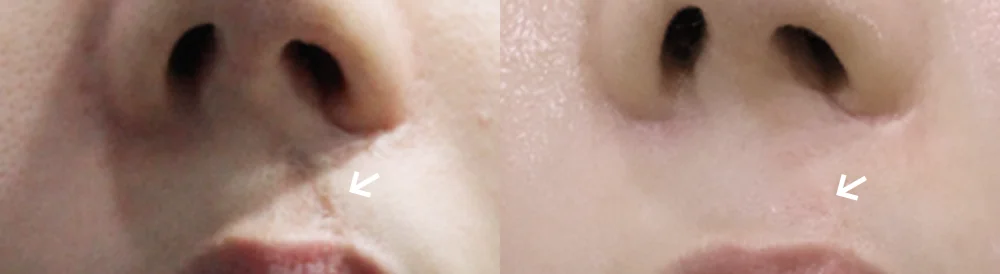 수두·마마·구순열 흉터 시술 전후 사진 6 · 보니따의원