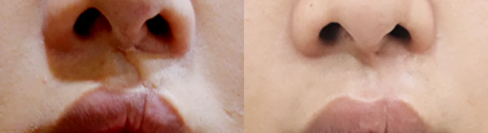 수두·마마·구순열 흉터 시술 전후 사진 7 · 보니따의원