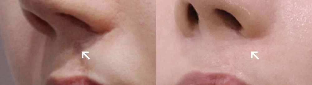 수두·마마·구순열 흉터 시술 전후 사진 12 · 보니따의원